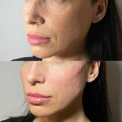 How Long Will Lips Be Sore After Fillers?