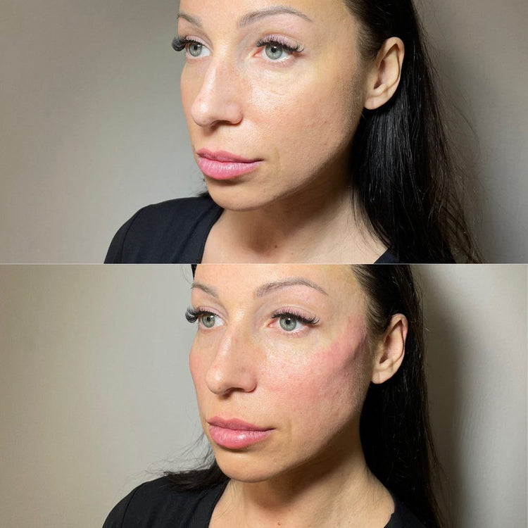 Dermal Fillers and Facial Symmetry: Balancing Features for a Harmonious Look