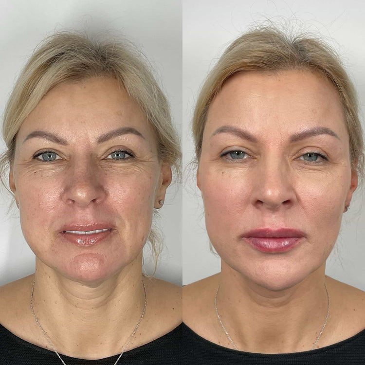 Botox Forehead Frown Lines in Weybridge, Surrey