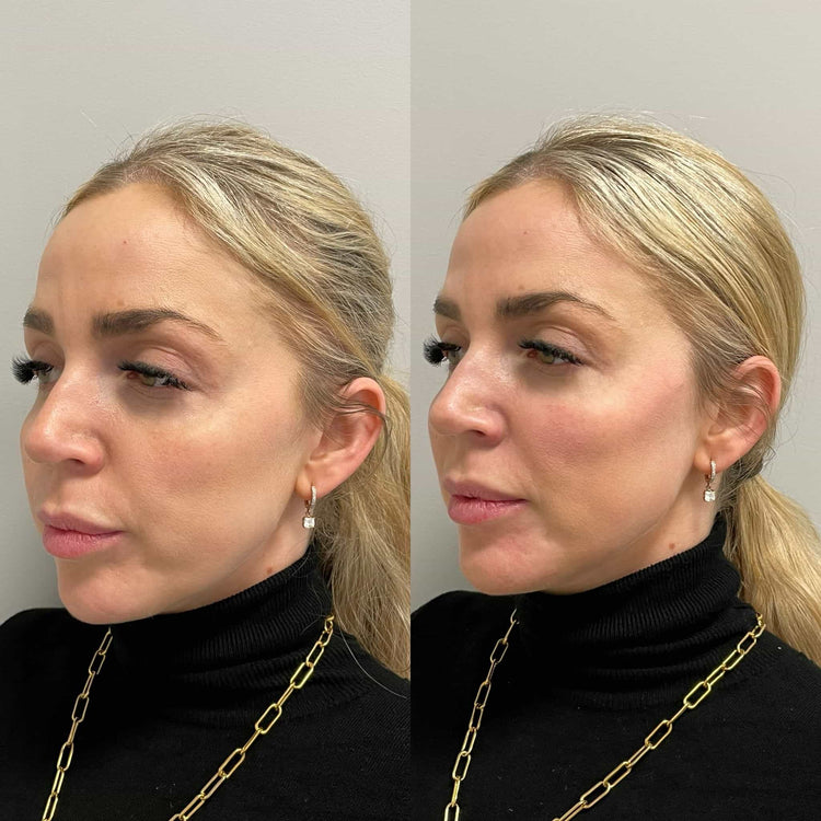 Skin Booster For Dark Circles in Horsell, Surrey