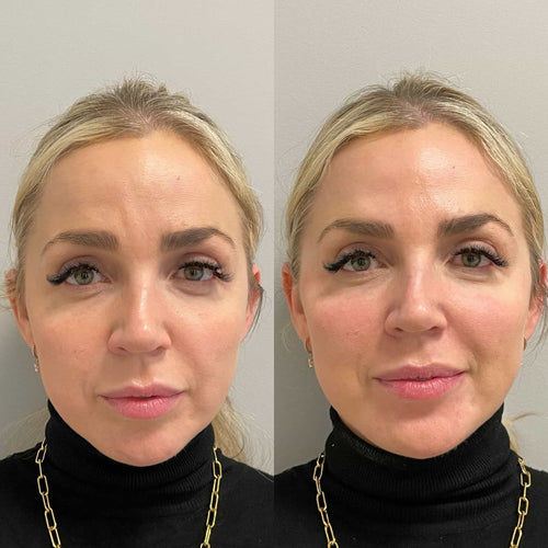 What Is The Best Nonsurgical Facelift?