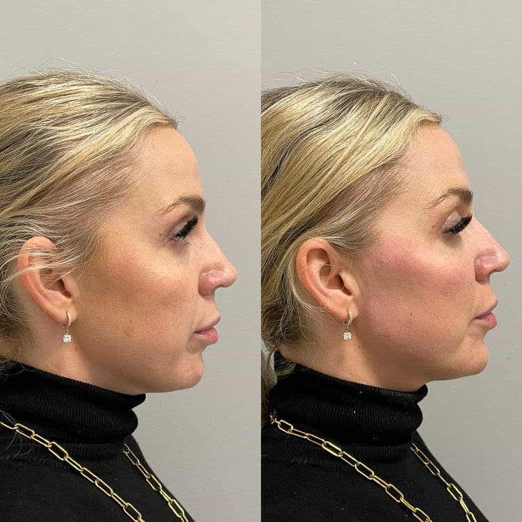 Botox Forehead Frown Lines in Weybridge, Surrey