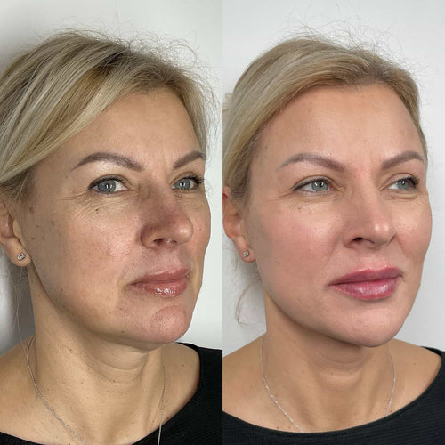 Why Do I Look Like Maleficent After Cheek Fillers?