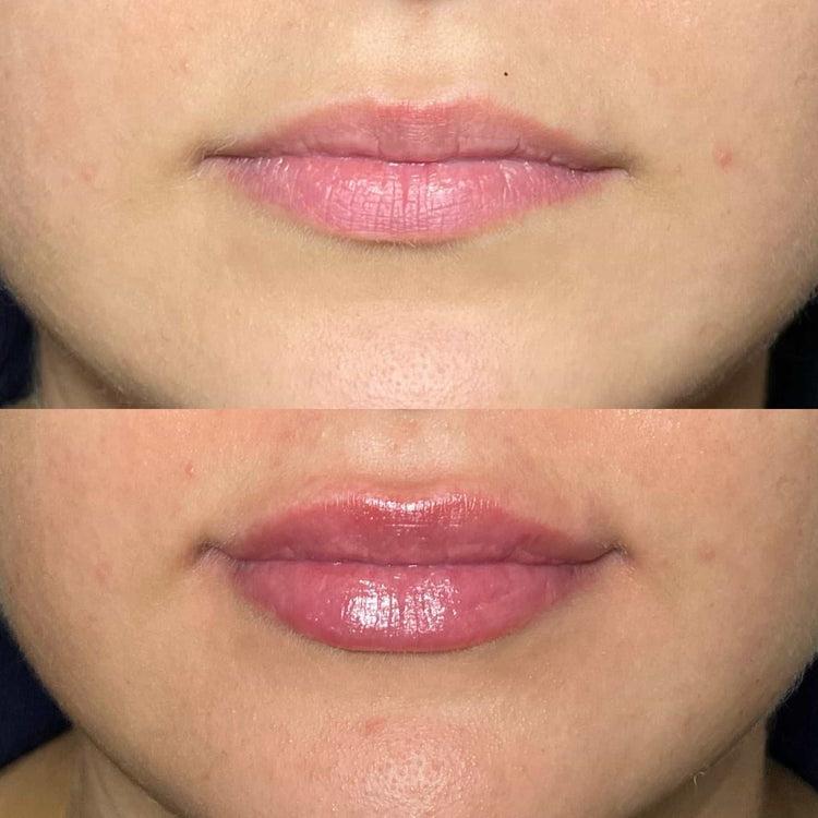 Non-Surgical Lip Enhancement Options in the UK