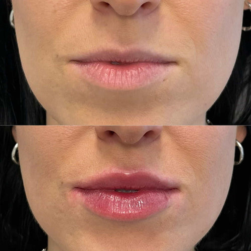 How Long Does Lip Filler Take To Dissolve Naturally