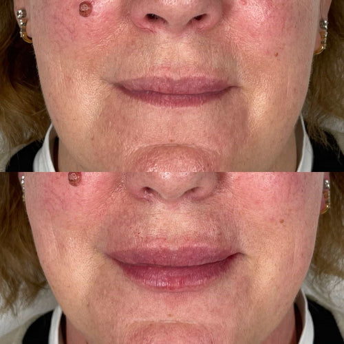 Do Temples Swell After Filler?