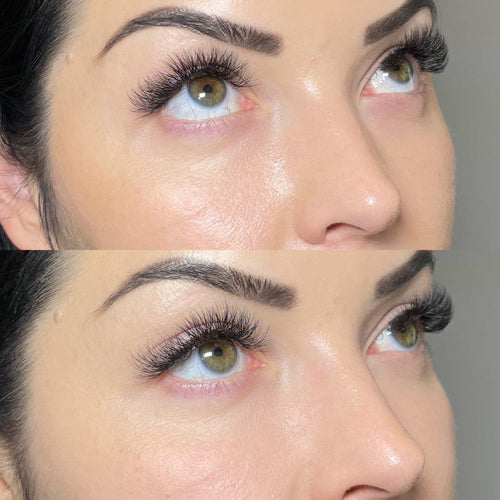 What Is A Lip Flip Vs Filler