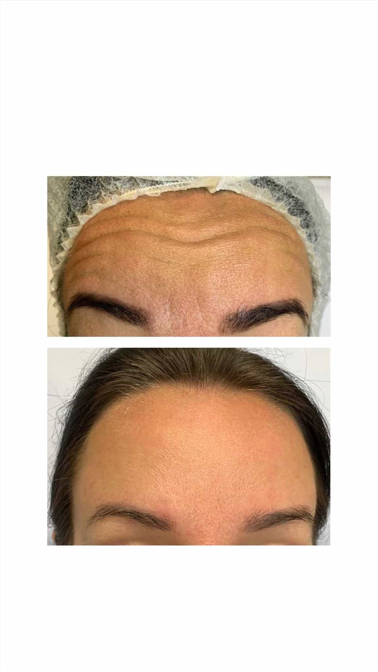 Neauvia Hydro Deluxe in Chertsey, Surrey